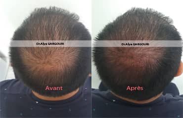 prp cheveux tunisie,prp vidage tunisie