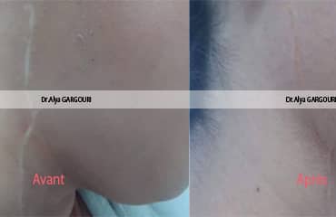 maquillage permanent aréoles mammaire tunisie,photos avant après maquillage permanent aréoles mammaire ariana